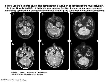 Figure Longitudinal MRI study data demonstrating evolution of central pontine myelinolysis(A, B) Axial T2-weighted MRI of the brain from January 9, 2014,