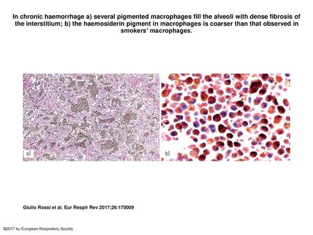 In chronic haemorrhage a) several pigmented macrophages fill the alveoli with dense fibrosis of the interstitium; b) the haemosiderin pigment in macrophages.