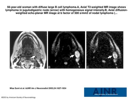 56-year-old woman with diffuse large B cell lymphoma