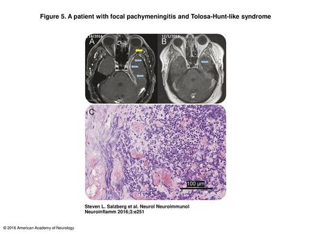 Figure 5. A patient with focal pachymeningitis and Tolosa-Hunt-like syndrome A patient with focal pachymeningitis and Tolosa-Hunt-like syndrome (A) Neuroimaging.