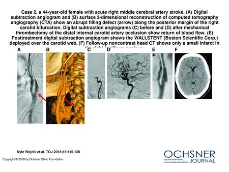 Case 2, a 44-year-old female with acute right middle cerebral artery stroke. (A) Digital subtraction angiogram and (B) surface 3-dimensional reconstruction.