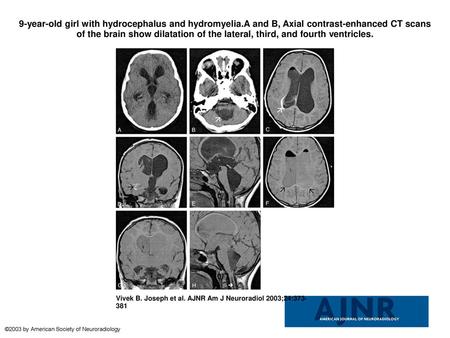 9-year-old girl with hydrocephalus and hydromyelia