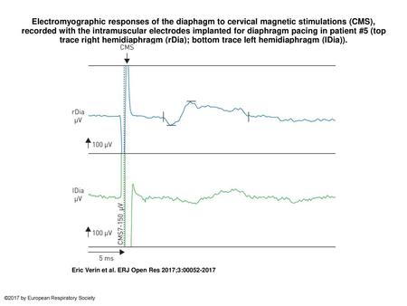 Electromyographic responses of the diaphagm to cervical magnetic stimulations (CMS), recorded with the intramuscular electrodes implanted for diaphragm.