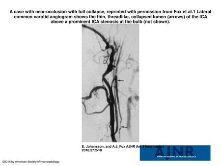 A case with near-occlusion with full collapse, reprinted with permission from Fox et al.1 Lateral common carotid angiogram shows the thin, threadlike,