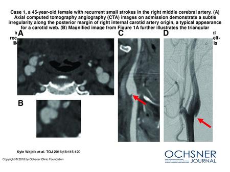 Case 1, a 45-year-old female with recurrent small strokes in the right middle cerebral artery. (A) Axial computed tomography angiography (CTA) images on.