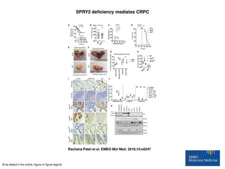 SPRY2 deficiency mediates CRPC