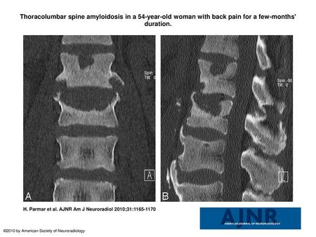 Thoracolumbar spine amyloidosis in a 54-year-old woman with back pain for a few-months' duration. Thoracolumbar spine amyloidosis in a 54-year-old woman.