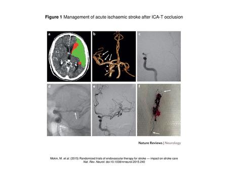 Figure 1 Management of acute ischaemic stroke after ICA-T occlusion