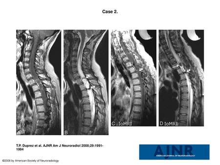 Case 2. Case 2. Preoperative images. Midsagittal contrast-enhanced FSE T1- (A) and T2-weighted (B) views showed the usual features of spinal cord ependymoma.