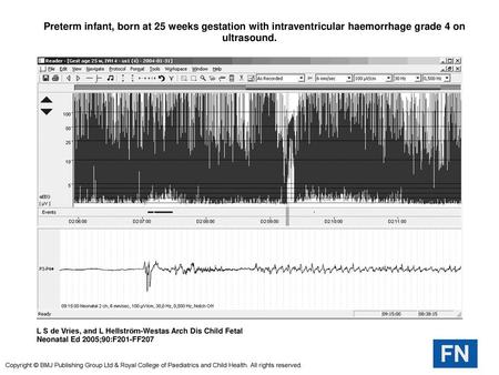  Preterm infant, born at 25 weeks gestation with intraventricular haemorrhage grade 4 on ultrasound.  Preterm infant, born at 25 weeks gestation with intraventricular.