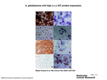 A. glioblastoma with high (+++) KIT protein expression.