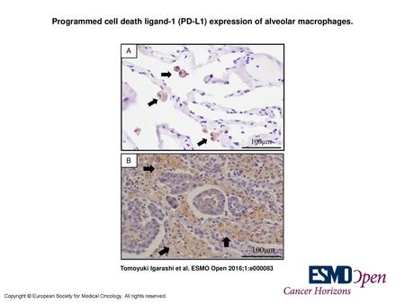 Programmed cell death ligand-1 (PD-L1) expression of alveolar macrophages. Programmed cell death ligand-1 (PD-L1) expression of alveolar macrophages. (A)