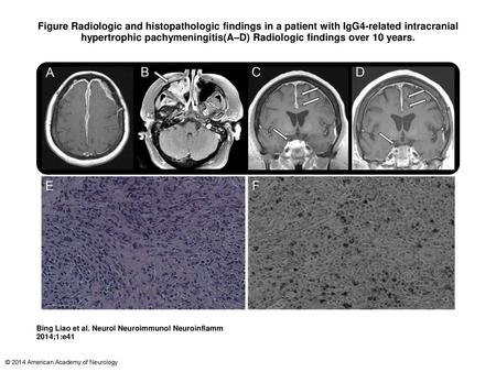Figure Radiologic and histopathologic findings in a patient with IgG4-related intracranial hypertrophic pachymeningitis(A–D) Radiologic findings over 10.