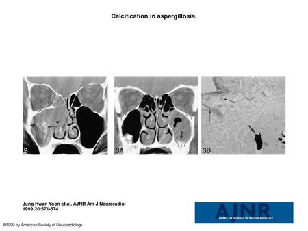 Calcification in aspergillosis.