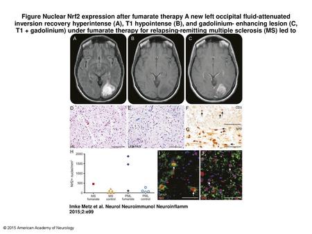 Figure Nuclear Nrf2 expression after fumarate therapy A new left occipital fluid-attenuated inversion recovery hyperintense (A), T1 hypointense (B), and.