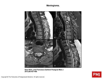 Meningioma. Meningioma. (A) T1 weighted image demonstrates a well-circumscribed intradural extramedullary mass that is isointense to the spinal cord. (B)