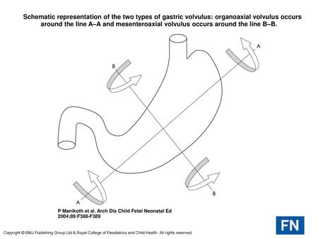  Schematic representation of the two types of gastric volvulus: organoaxial volvulus occurs around the line A–A and mesenteroaxial volvulus occurs around.