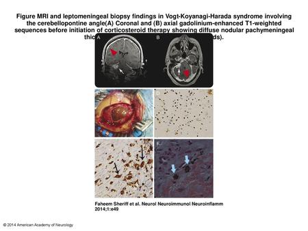 Figure MRI and leptomeningeal biopsy findings in Vogt-Koyanagi-Harada syndrome involving the cerebellopontine angle(A) Coronal and (B) axial gadolinium-enhanced.