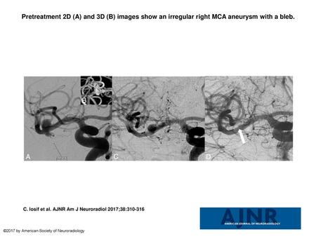Pretreatment 2D (A) and 3D (B) images show an irregular right MCA aneurysm with a bleb. Pretreatment 2D (A) and 3D (B) images show an irregular right MCA.