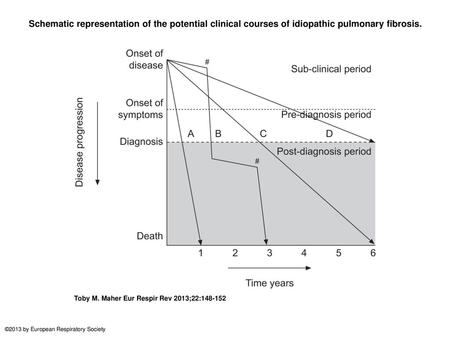 Schematic representation of the potential clinical courses of idiopathic pulmonary fibrosis. Schematic representation of the potential clinical courses.