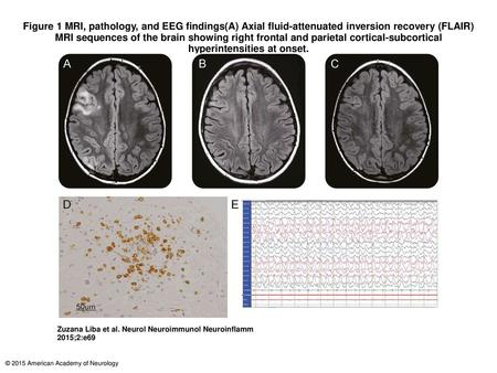 Figure 1 MRI, pathology, and EEG findings(A) Axial fluid-attenuated inversion recovery (FLAIR) MRI sequences of the brain showing right frontal and parietal.
