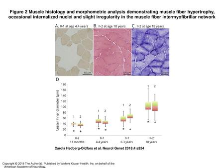 Figure 2 Muscle histology and morphometric analysis demonstrating muscle fiber hypertrophy, occasional internalized nuclei and slight irregularity in the.
