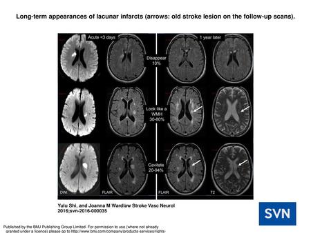 Long-term appearances of lacunar infarcts (arrows: old stroke lesion on the follow-up scans). Long-term appearances of lacunar infarcts (arrows: old stroke.