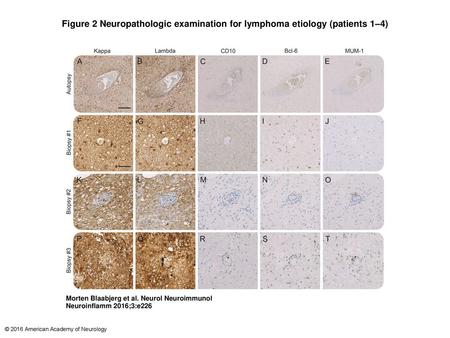 Figure 2 Neuropathologic examination for lymphoma etiology (patients 1–4)‏ Neuropathologic examination for lymphoma etiology (patients 1–4) Immunohistochemical.