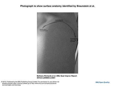 Photograph to show surface anatomy identified by Braunstein et al.