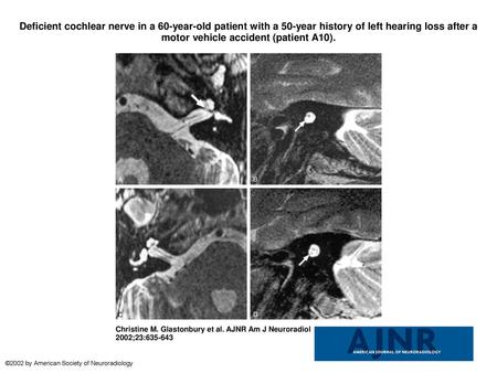 Deficient cochlear nerve in a 60-year-old patient with a 50-year history of left hearing loss after a motor vehicle accident (patient A10). Deficient cochlear.