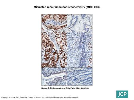 Mismatch repair immunohistochemistry (MMR IHC).