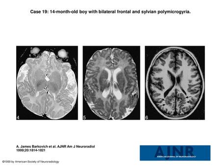 Case 19: 14-month-old boy with bilateral frontal and sylvian polymicrogyria. Case 19: 14-month-old boy with bilateral frontal and sylvian polymicrogyria.