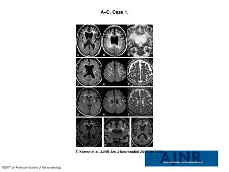 A–C, Case 1. A–C, Case 1. Typical white matter changes involving the corpus callosum and the pyramidal tracts (A and C, arrows), dilation of the lateral.