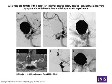 A 46-year-old female with a giant left internal carotid artery carotid–ophthalmic aneurysm symptomatic with headaches and left eye vision impairment. A.