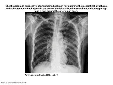 Chest radiograph suggestive of pneumomedia­stinum (air outlining the mediastinal structures) and ­subcutaneous emphysema in the area of the left axilla,