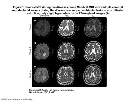 Figure 1 Cerebral MRI during the disease course Cerebral MRI with multiple cerebral supratentorial lesions during the disease course: periventricular lesions.