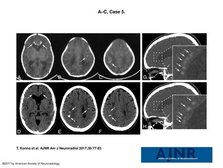A–C, Case 5. A–C, Case 5. Axial CT images at 1 month after birth show bilateral frontal and parietal calcifications (arrows). D–F, These calcifications.