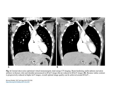 Fig. 4. Coronal chest noise-optimized virtual monoenergetic dual-energy CT imaging. Beam-hardening and/or photon starvation artifacts in thoracic inlet.