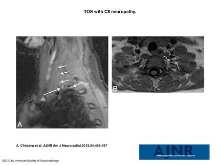 TOS with C8 neuropathy. TOS with C8 neuropathy. A 17-year-old girl (trumpet player) with left arm and hand weakness in an ulnar distribution, exacerbated.