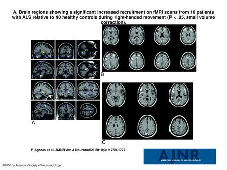 A, Brain regions showing a significant increased recruitment on fMRI scans from 10 patients with ALS relative to 10 healthy controls during right-handed.