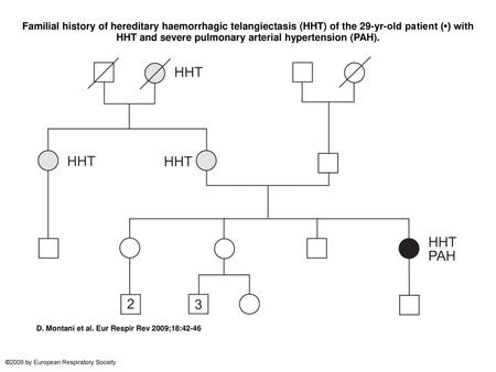 Familial history of hereditary haemorrhagic telangiectasis (HHT) of the 29-yr-old patient (•) with HHT and severe pulmonary arterial hypertension (PAH).