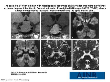 The case of a 64-year-old man with histologically confirmed pituitary adenoma without evidence of hemorrhage or infarction.A, Coronal spin-echo T1-weighted.