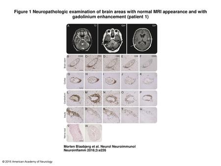 Figure 1 Neuropathologic examination of brain areas with normal MRI appearance and with gadolinium enhancement (patient 1)‏ Neuropathologic examination.