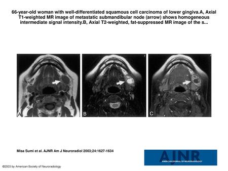 66-year-old woman with well-differentiated squamous cell carcinoma of lower gingiva.A, Axial T1-weighted MR image of metastatic submandibular node (arrow)