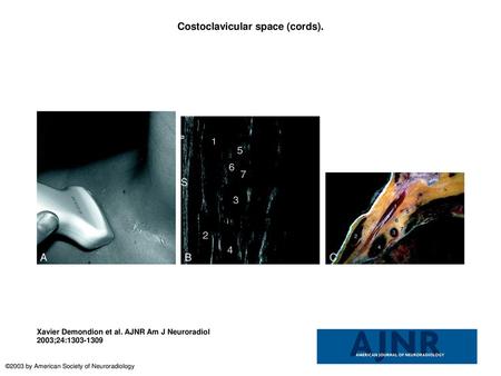 Costoclavicular space (cords).
