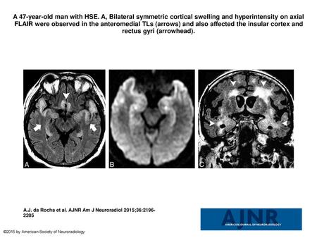 A 47-year-old man with HSE