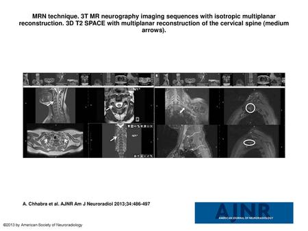 MRN technique. 3T MR neurography imaging sequences with isotropic multiplanar reconstruction. 3D T2 SPACE with multiplanar reconstruction of the cervical.