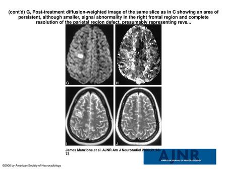 (cont'd) G, Post-treatment diffusion-weighted image of the same slice as in C showing an area of persistent, although smaller, signal abnormality in the.