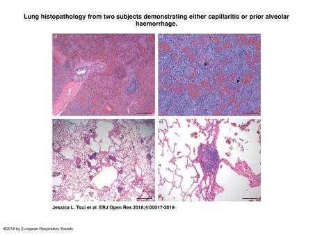 Lung histopathology from two subjects demonstrating either capillaritis or prior alveolar haemorrhage. Lung histopathology from two subjects demonstrating.