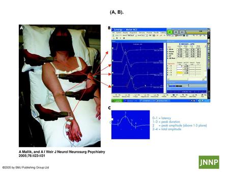  (A, B).  (A, B). Median motor nerve conduction study. Active recording electrode is over the APB muscle, with stimulation at the wrist, elbow, axilla,